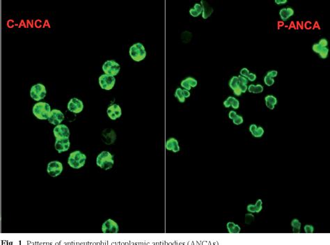 Antineutrophil cytoplasmic antibodies (ANCA) testing: detection methods ...