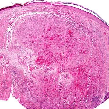 Angiolymphoid Hyperplasia With Eosinophilia | Basicmedical Key