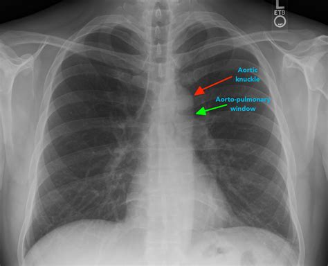 Αποτέλεσμα εικόνας για aortic arch chest x ray Thorax, Radiology, X Ray, Houston, Approach ...