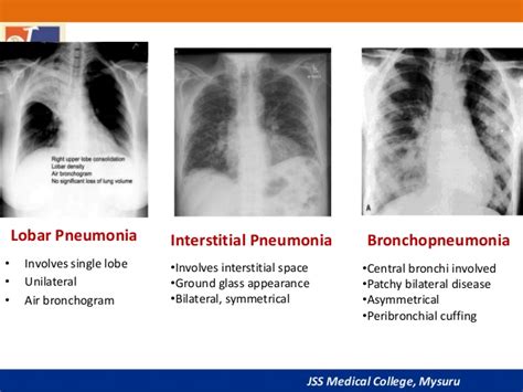 Pneumonia clinical Aspect and Rational Treatment ~ Pharmacy Portal