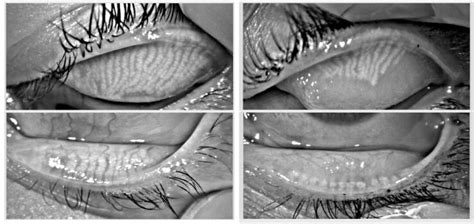 what causes meibomian glands to stop producing oils - Burns Scatinstund