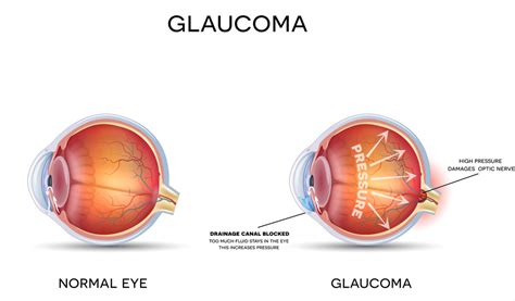 What Is Tunnel Vision, and Can It Be Fixed or Prevented? | NVISION Eye ...