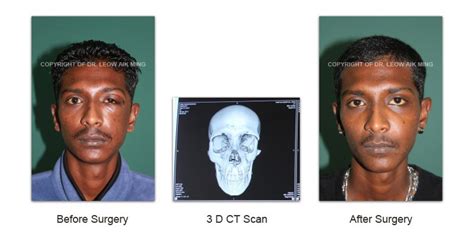 Craniofacial Trauma Reconstruction – MSPRS