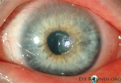 Atlas Entry - Palpebral vernal keratoconjunctivitis (VKC)