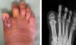Diabetic foot ulcer pictures, foot ulcer stages pictures, diabetic toes pictures, diabetic ...