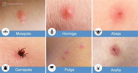 Aprende a identificar las picaduras de insectos en los niños | Paw print tattoo, Health, Health ...