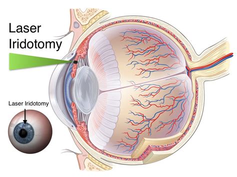 Laser Iridotomy for Glaucoma - Glaucoma Associates of Texas