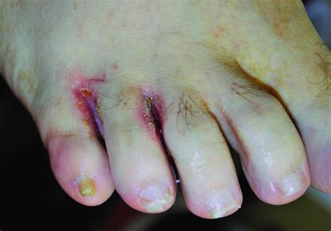 Onychomycosis causes, clinical appearance and onychomycosis treatment