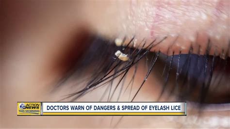 Doctors warn of lice found in eyelash extensions