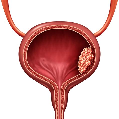 Bladder Cancer — Pacific West Urology