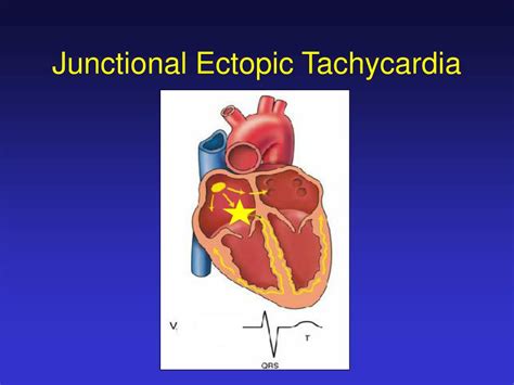 PPT - Supraventricular Arrhythmias PowerPoint Presentation, free ...