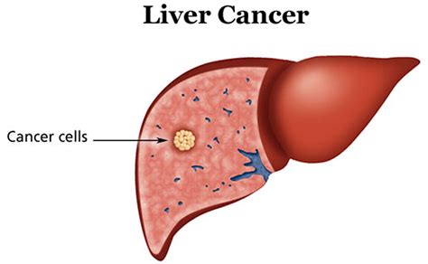 Liver Cancer - Causes, Symptoms, Diagnosis, Prognosis and Treatment