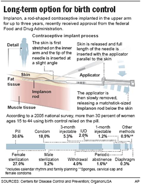 FDA approves implantable contraceptive