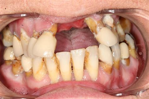 PHOTOS: Woman Scared Of Dentists Superglued Her Teeth For 10 Years - INFORMATION NIGERIA