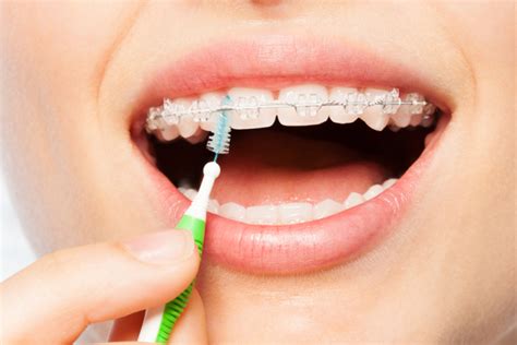 Tips for Flossing with Braces: Know how these tips may help you.