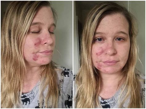 Woman hails £85 skincare kit as ‘miracle cure’ for her cystic acne | The Independent