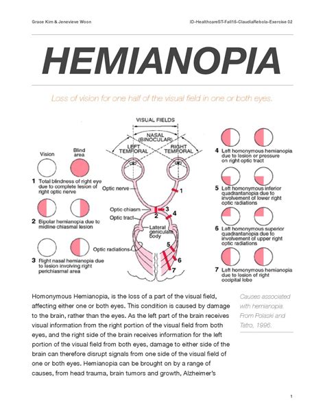 Hemianopia by Jenevieve Woon - Issuu