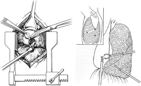 Subxiphoid Pericardial Drainage For Pericardial Tamponade, 47% OFF