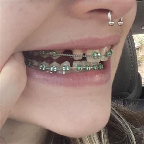 braces progress (so far) : r/braces