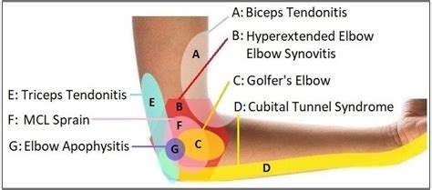 Elbow Pain Diagram: Diagnosis Chart | Elbow pain, Nerve pain relief, Forearm pain