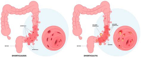 Antibiotics | Free Full-Text | Diverticular Disease and Rifaximin: An ...