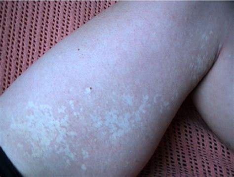 nevus depigmentosus causes white spots on skin