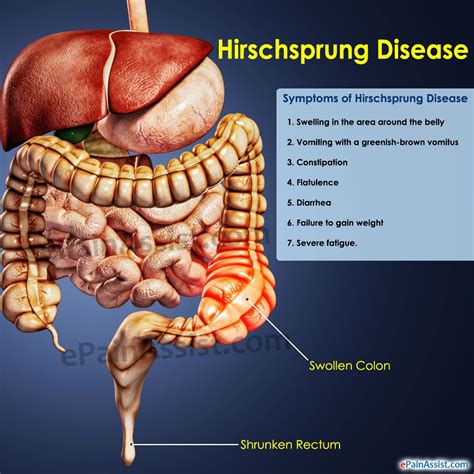 Hirschsprung Disease | Pediatric care, Pediatric surgery, Pediatric nursing