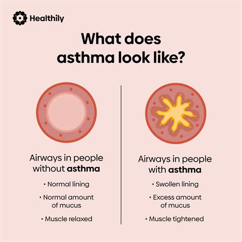 Severe Asthma: Symptoms, Treatment, And More, 42% OFF