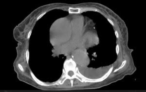 Omentum Cancer - Symptoms, Causes, Treatment