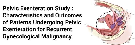 Pelvic Exenteration Study: Characteristics and Outcomes of Patients Undergoing Pelvic ...