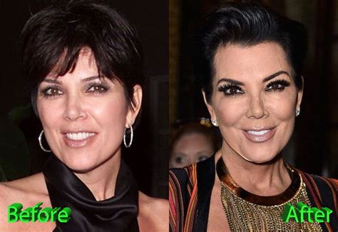 Kris Jenner Plastic Surgery: A Really Beautiful Granny