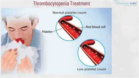 Thrombocytopenia Treatment Cost In India | Thrombocytopenia Treatment