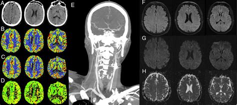 (A-E) Computed tomography: A) baseline axial CT slice showing sulcal... | Download Scientific ...