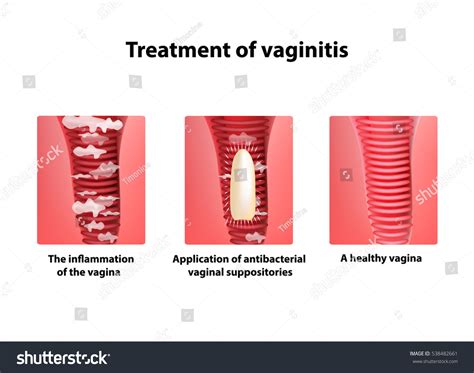 Treatment Vaginitis Suppositories Inflammation Vagina Infographics Stock Illustration 538482661 ...