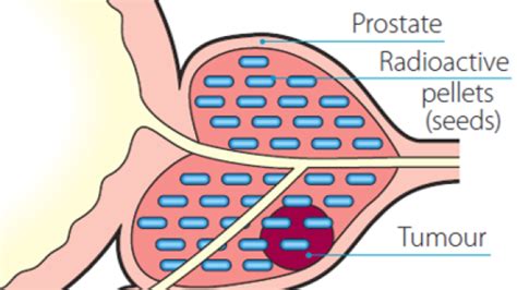 What Are The Side Effects Of Brachytherapy For Prostate Cancer? Here Is ...