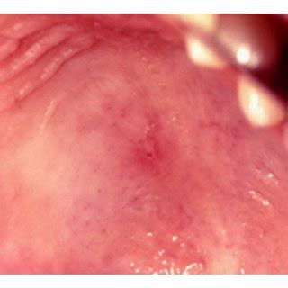 The clinical photograph shows a lesion on the posterior hard palate,... | Download Scientific ...