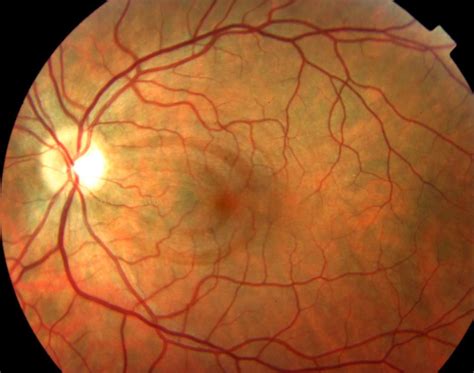 Retinal Photography & Optical Coherence Tomography: Prominent Retinal Nerve Fiber Layer