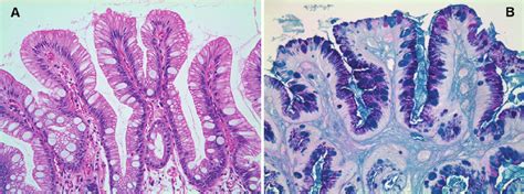 Intestinal-type columnar metaplasia (incomplete intestinal metaplasia):...