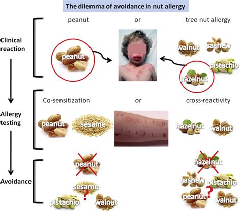 Managing Nut Allergy: A Remaining Clinical Challenge - The Journal of Allergy and Clinical ...