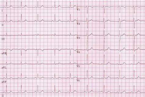 Normal Tracing - ECGpedia