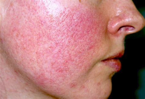 Acne Rosacea Causes and Diagnose – The Natural Cure