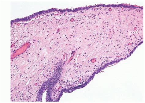 Wolffian Duct Cyst