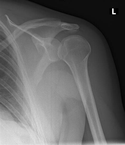 Shoulder Dislocation - Reduction - Immobilisation