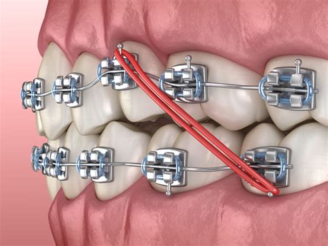 Orthodontic Elastics: Are They For You? | American Association of Orthodontists