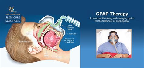 CPAP - Aviss Health