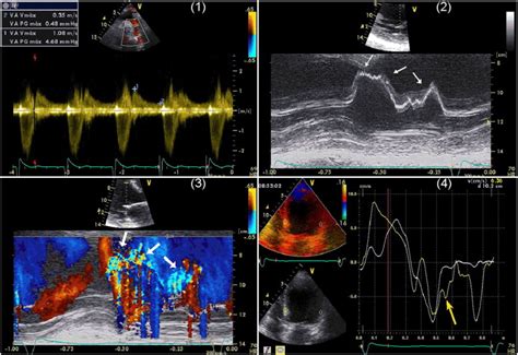 Austin Flint murmur re-visited - International Journal of Cardiology