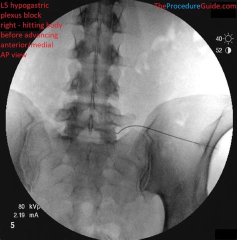 Hypogastric Plexus Block - Technique and Overview - The Procedure Guide