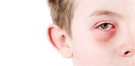 How do kids get pink eye? – killerinsideme.com