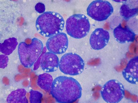 Burkitt lymphoma, touch prep, Wright stain | Cancer and Fucoidan