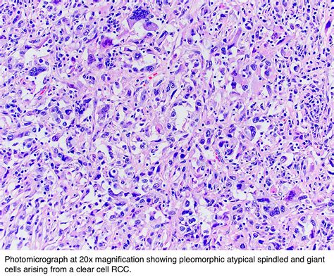 Pathology Outlines - Sarcomatoid